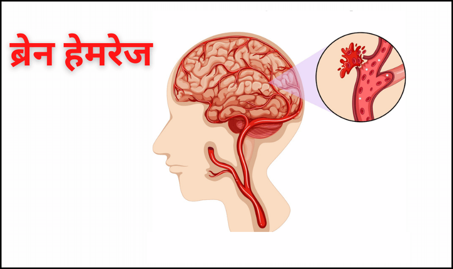 brain hemorrhage in hindi ब्रेन हेमरेज