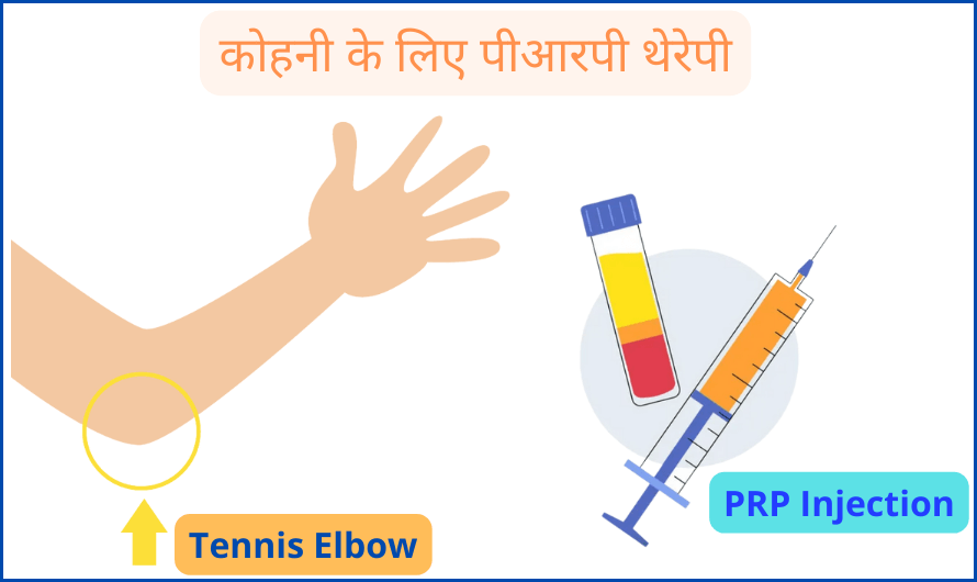 PRP Therapy for Tennis Elbow in Hindi