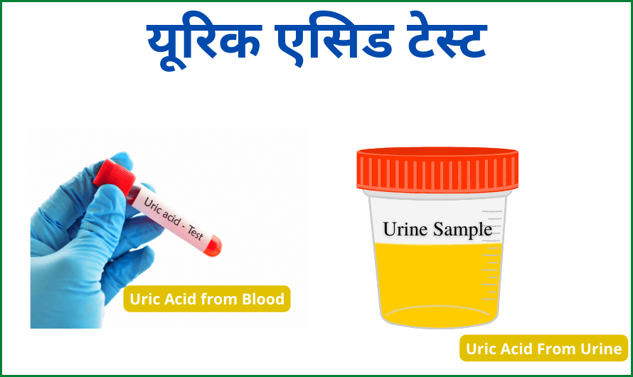 यूरिक एसिड टेस्ट – Uric Acid Test in Hindi