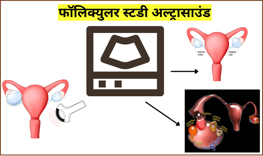 फॉलिक्युलर स्टडी अल्ट्रासाउंड – Follicular Study Ultrasound in Hindi