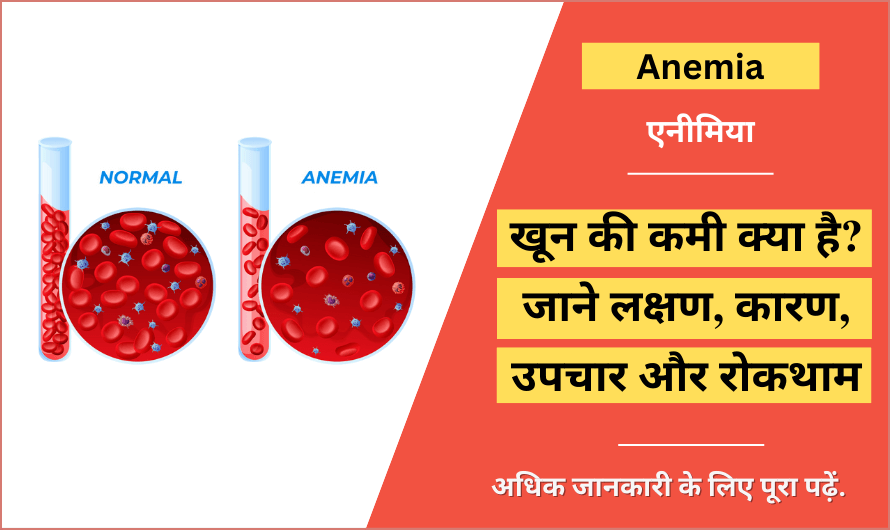 एनीमिया – Anemia in Hindi
