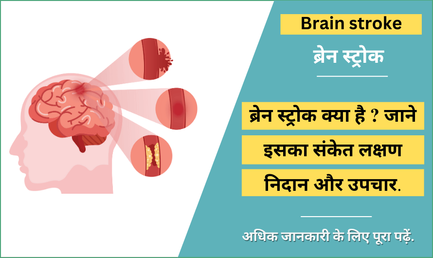 ब्रेन स्ट्रोक – Brain stroke in Hindi