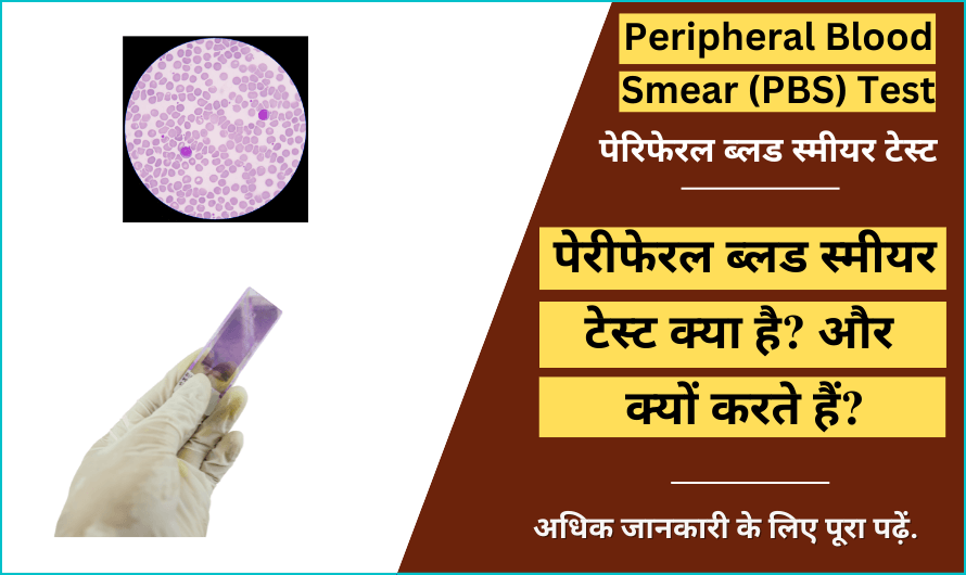पेरिफेरल ब्लड स्मीयर टेस्ट – Peripheral Blood Smear (PBS) Test in Hindi