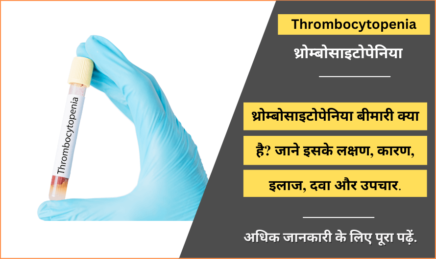 Thrombocytopenia in Hindi