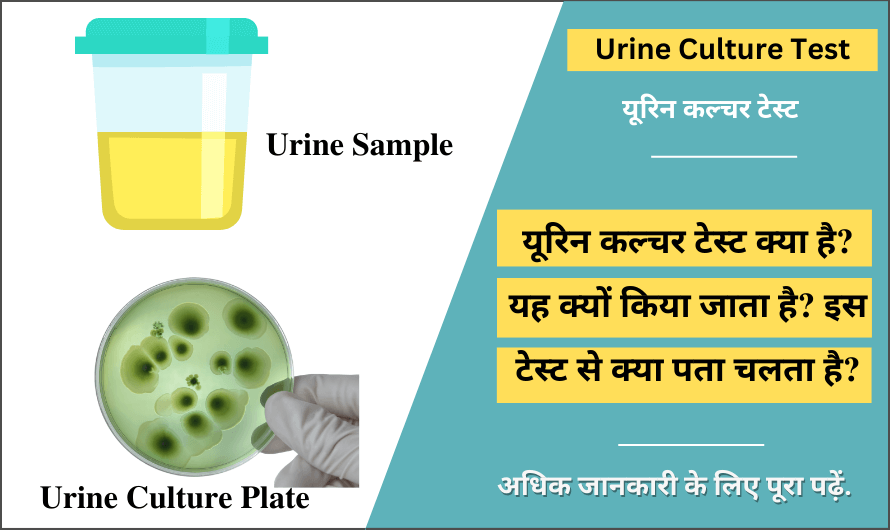 यूरिन कल्चर टेस्ट – Urine Culture Test in Hindi