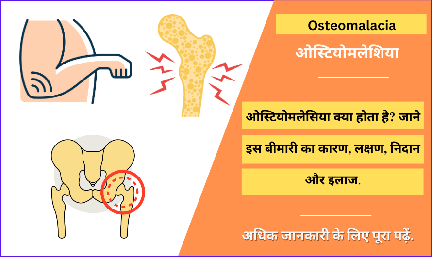 ओस्टियोमलेशिया – Osteomalacia in Hindi