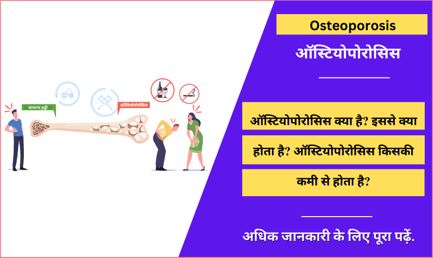 ऑस्टियोपोरोसिस – Osteoporosis Meaning in Hindi