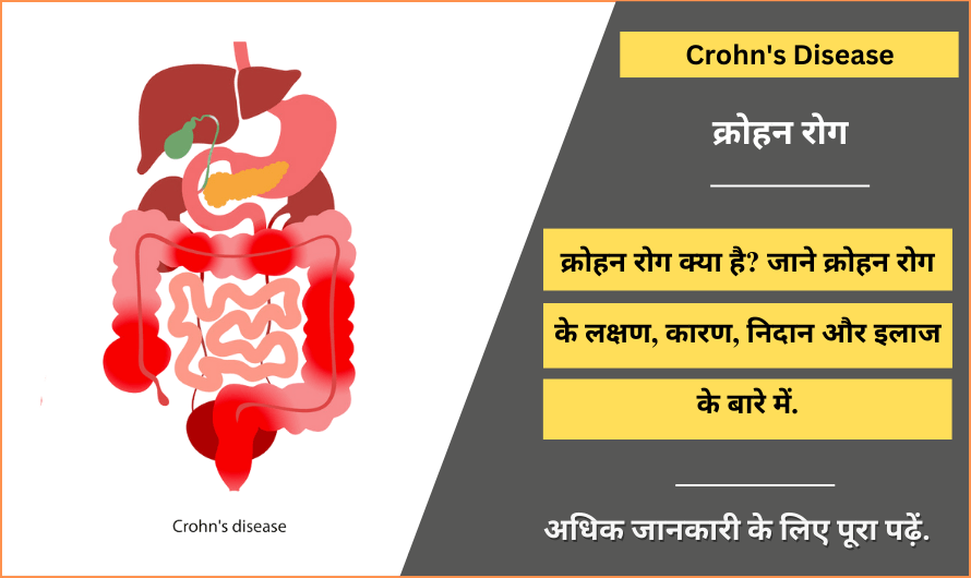 क्रोहन रोग – Crohn’s Disease in Hindi