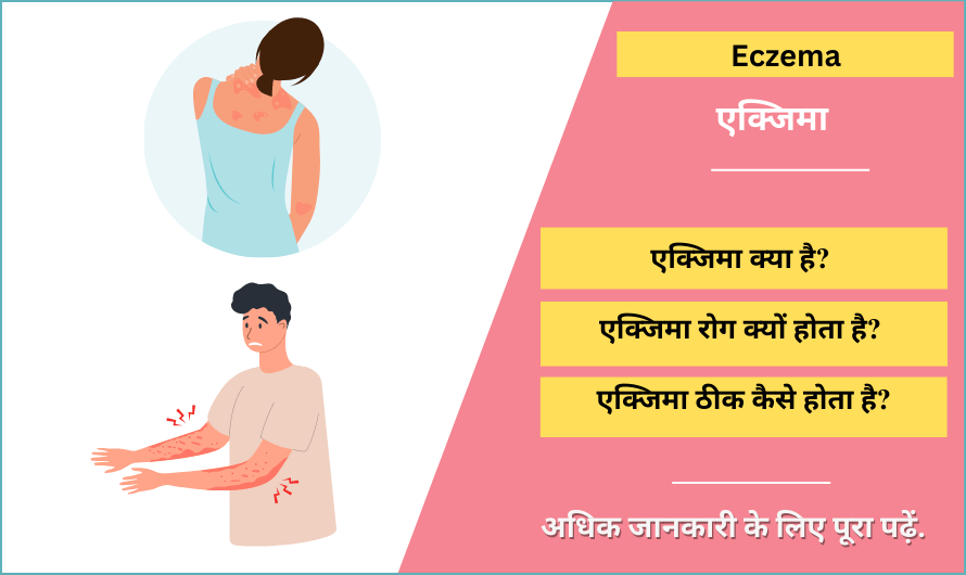 Eczema in Hindi