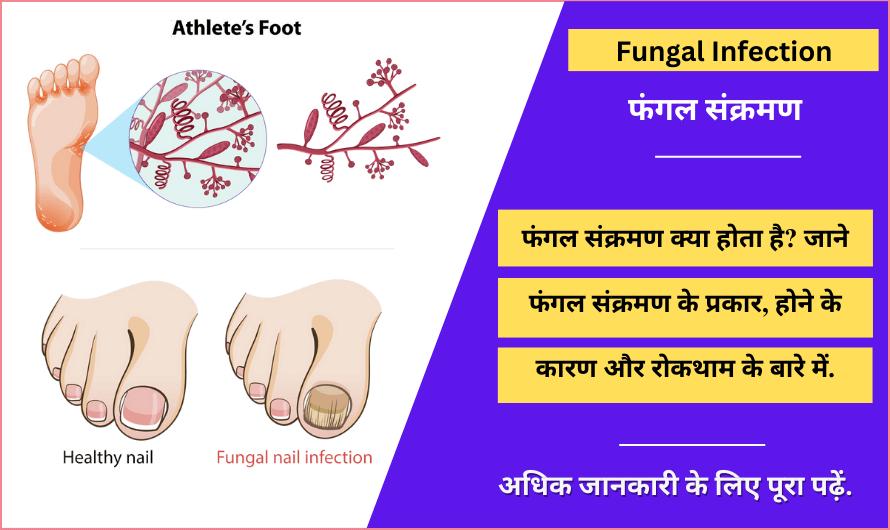 फंगल संक्रमण – Fungal Infection in Hindi