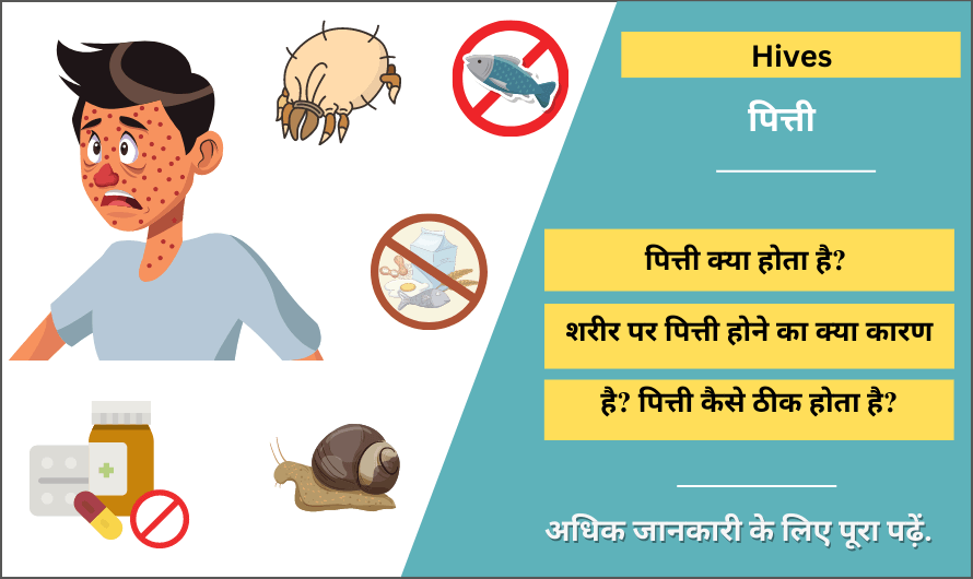 Hives in Hindi