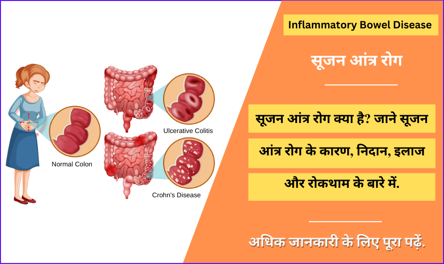 सूजन आंत्र रोग – Inflammatory Bowel Disease (IBD) in Hindi