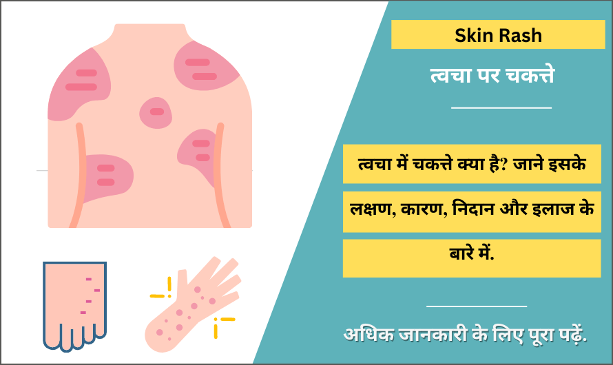 चकत्ते – Skin Rash in Hindi