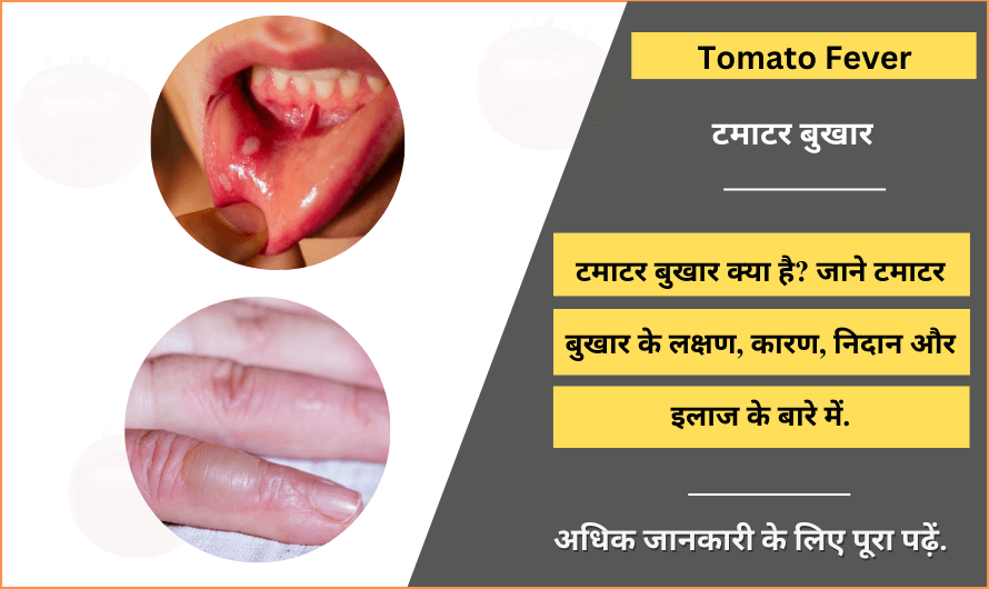 टमाटर बुखार – Tomato Fever in Hindi