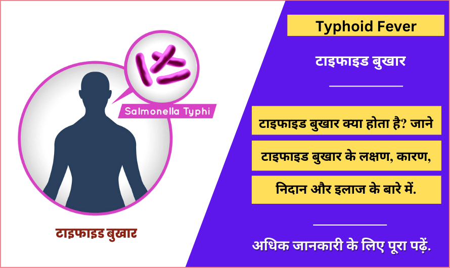 टाइफाइड बुखार Typhoid Fever in Hindi, Symptoms, Causes