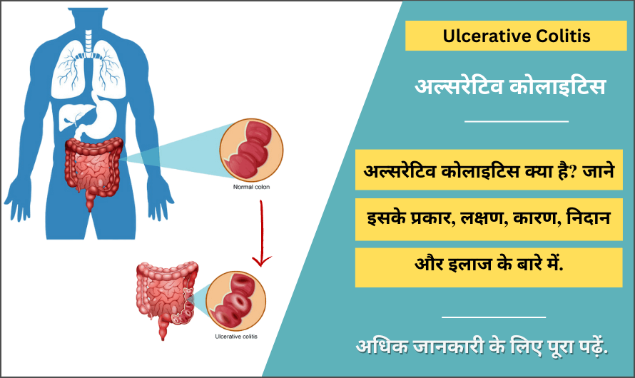 अल्सरेटिव कोलाइटिस – Ulcerative Colitis in Hindi