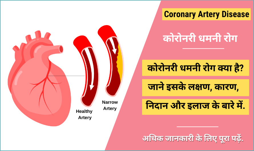 कोरोनरी धमनी रोग – Coronary Artery Disease in Hindi