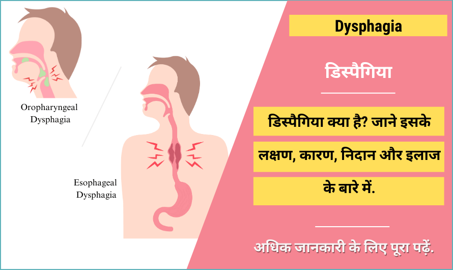 डिस्पैगिया – Dysphagia in Hindi