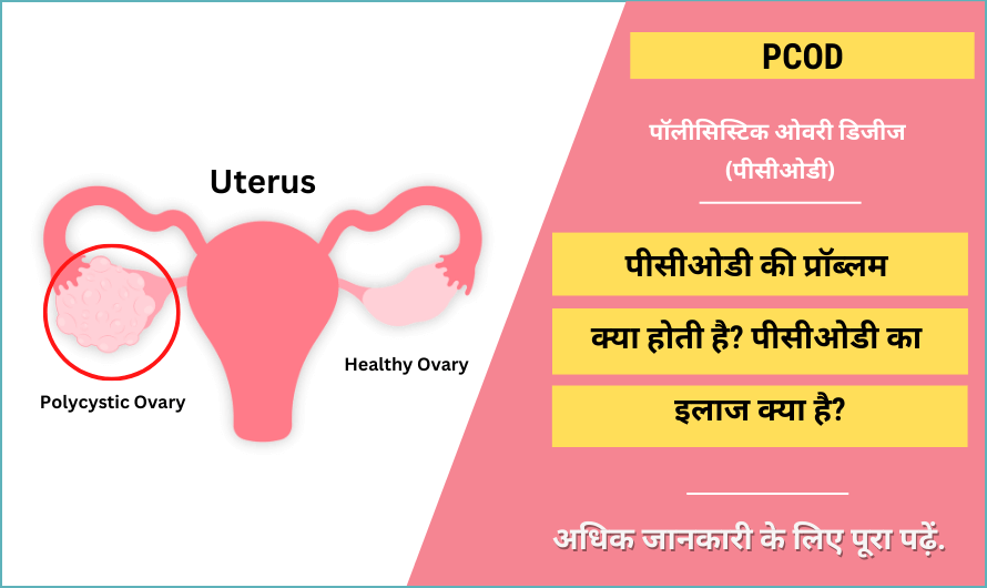 पॉलीसिस्टिक ओवरी डिजीज – Polycystic Ovary Disease (PCOD) in Hindi