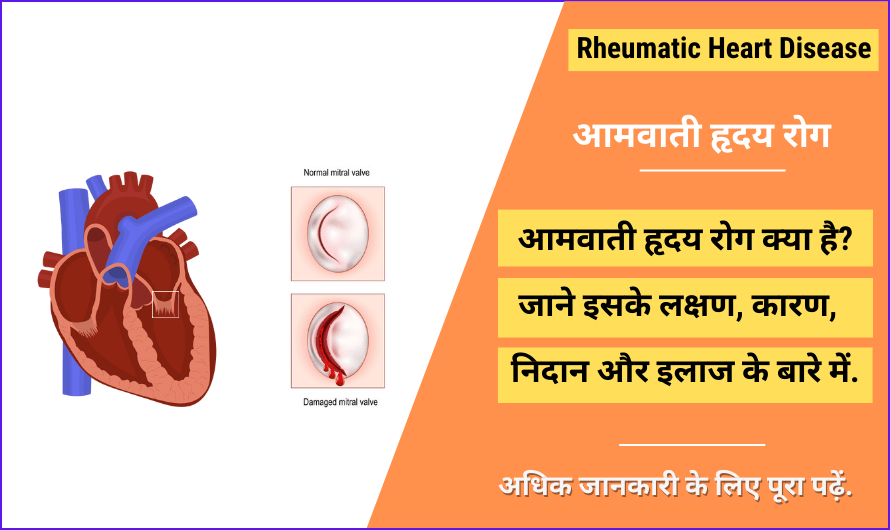 rheumatic-heart-disease-in-hindi-symptoms