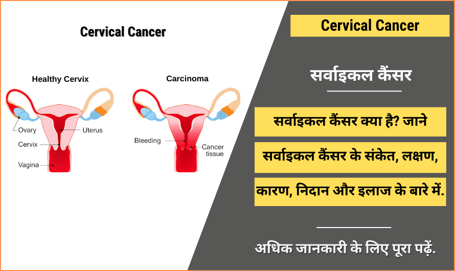 cervical-cancer-in-hindi-symptoms-treatment