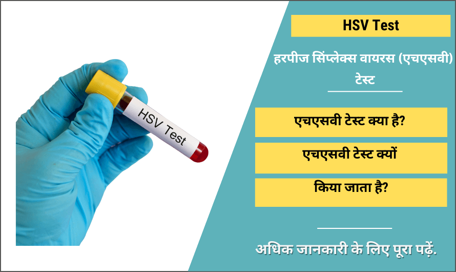 हर्पीस सिंप्लेक्स वायरस (एचएसवी) टेस्ट – HSV Test in Hindi