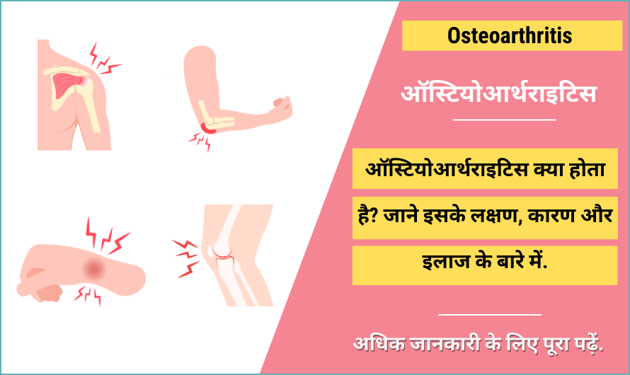 ऑस्टियोआर्थराइटिस – Osteoarthritis in Hindi
