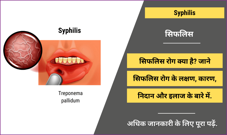 सिफलिस – Syphilis in Hindi
