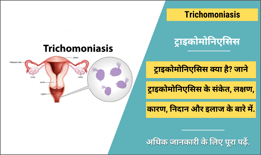 ट्राइकोमोनिएसिस – Trichomoniasis in Hindi