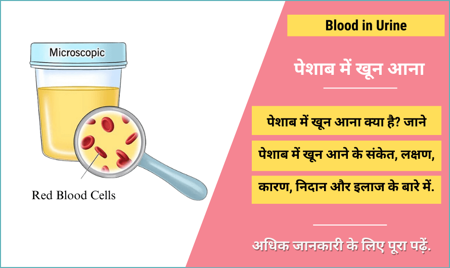 Blood in Urine in Hindi