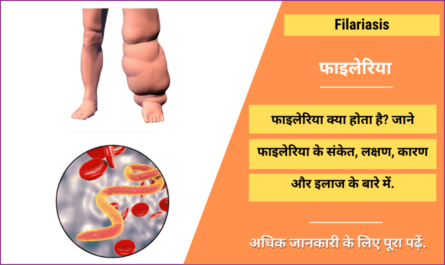Filariasis in Hindi