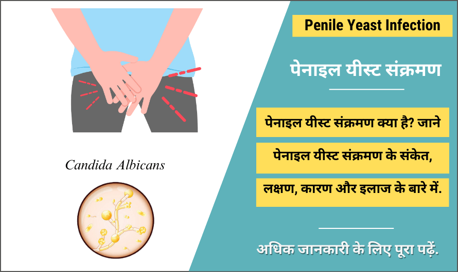 पेनाइल यीस्ट संक्रमण – Penile Yeast Infection in Hindi