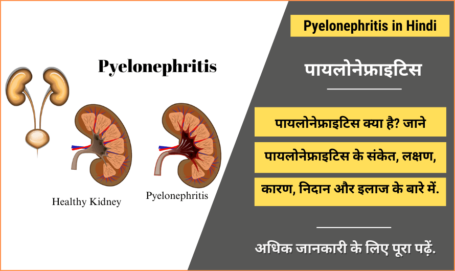 Pyelonephritis in Hindi
