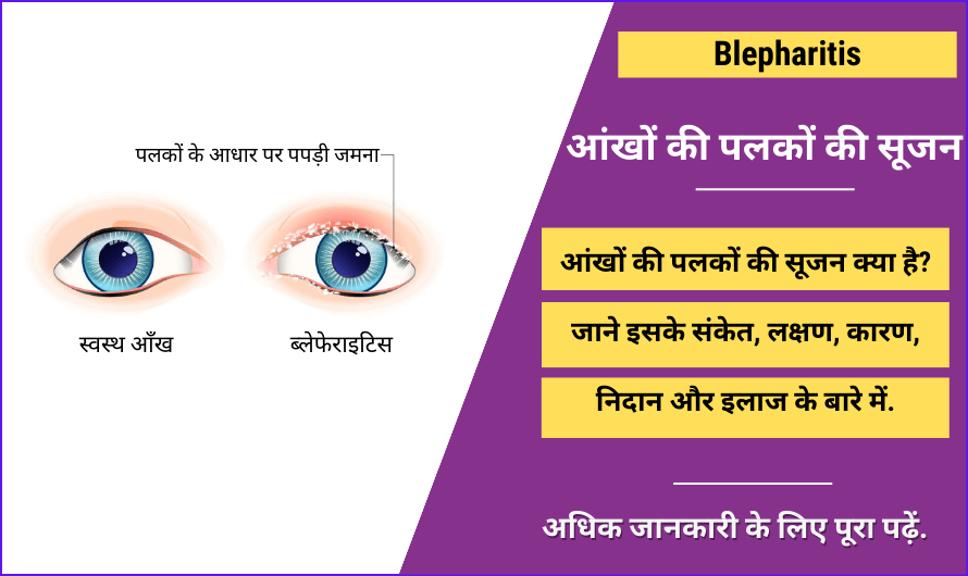 Blepharitis in Hindi