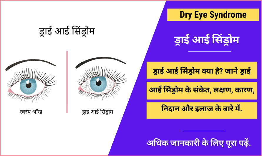 Dry Eye Syndrome in Hindi