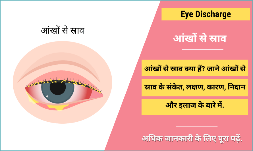 Eye Discharge in Hindi