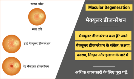 Macular Degeneration in Hindi