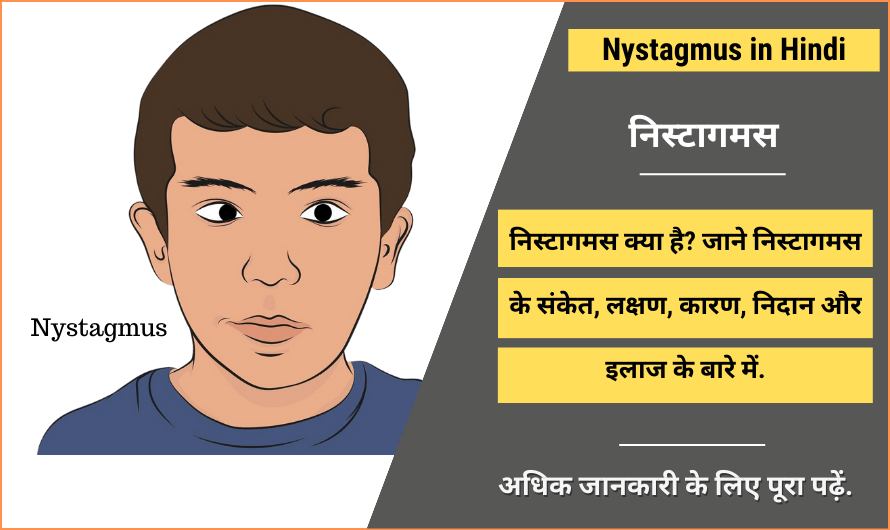 निस्टागमस – Nystagmus in Hindi