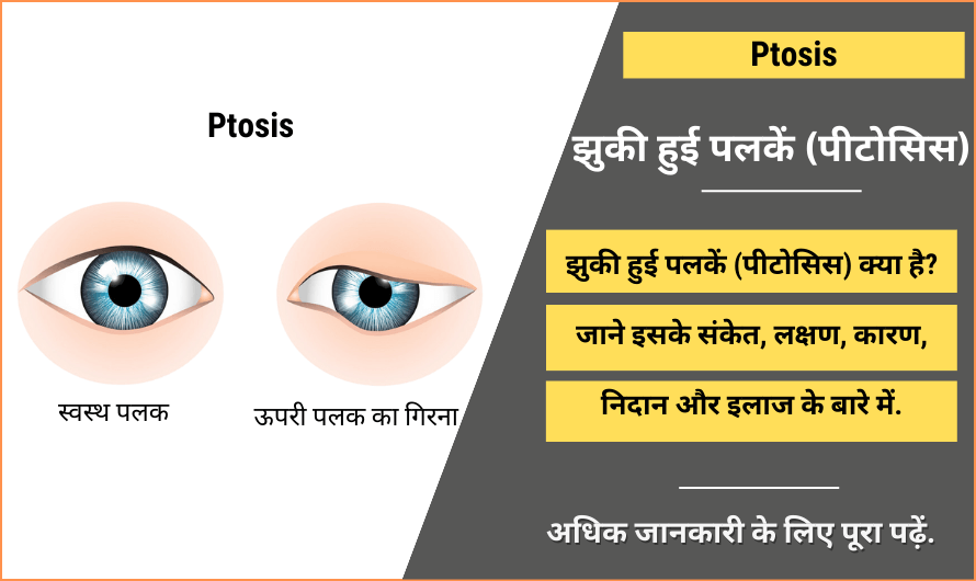 Ptosis in Hindi