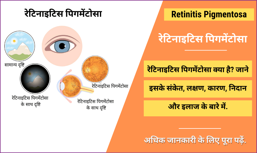 Retinitis Pigmentosa in Hindi