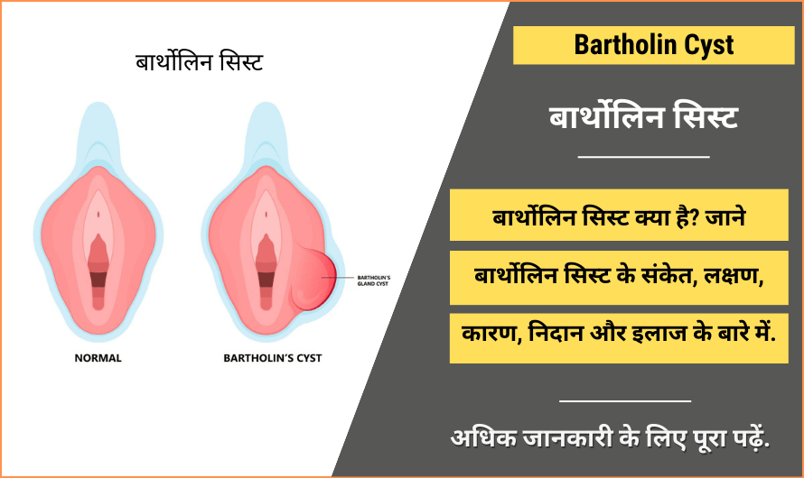 Bartholin Cyst in Hindi