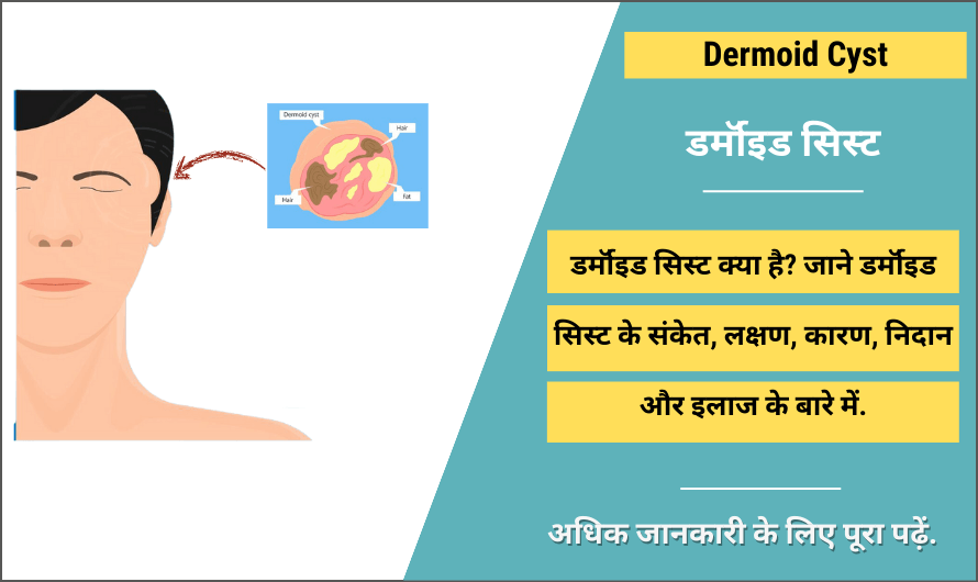 Dermoid Cyst in Hindi