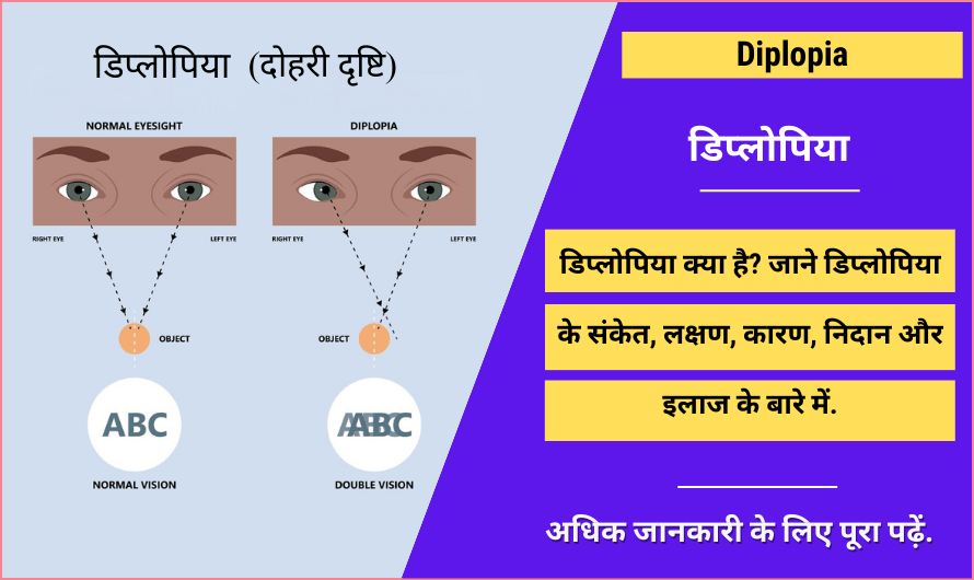 Diplopia in Hindi