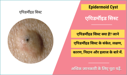 Epidermoid Cyst in Hindi
