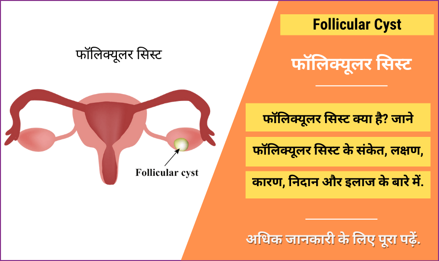 Follicular Cyst in Hindi