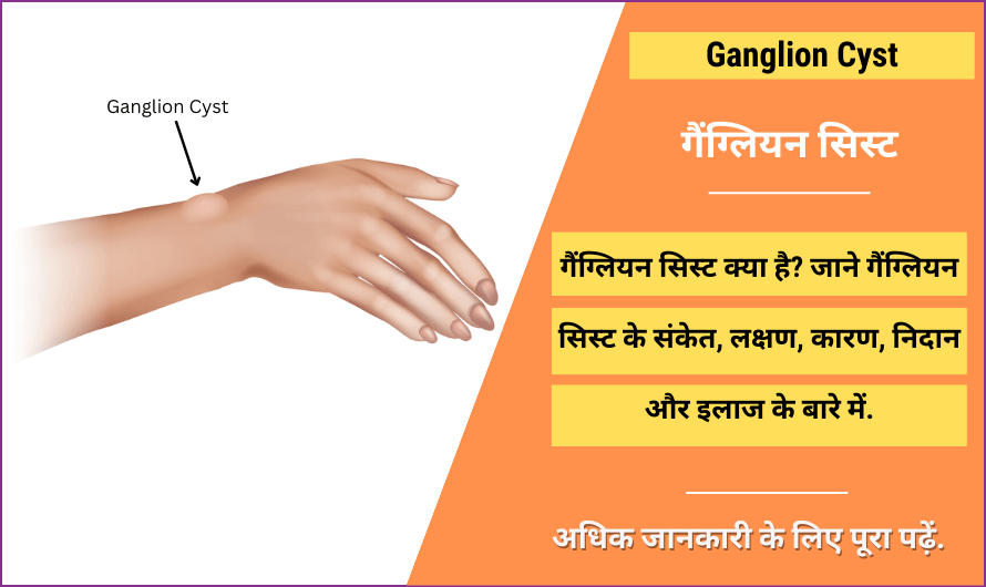 Ganglion Cyst in Hindi