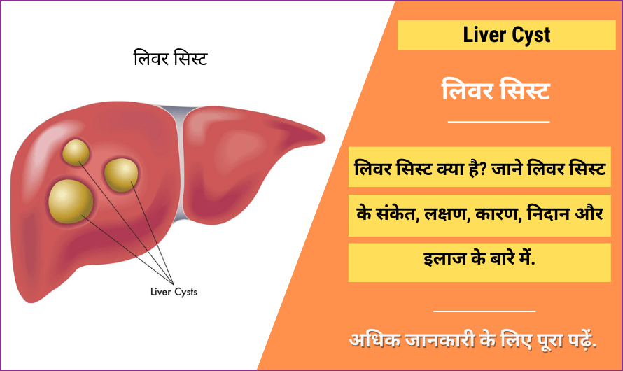 लिवर सिस्ट – Liver Cyst in Hindi