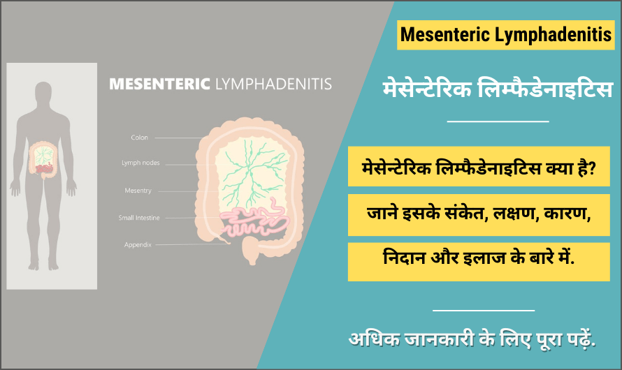 Mesenteric Lymphadenitis in Hindi
