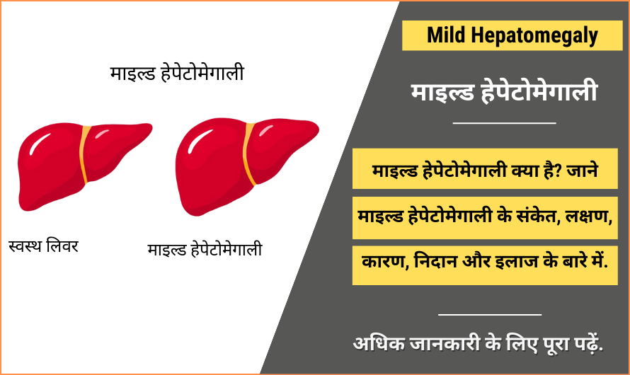 माइल्ड हेपेटोमेगाली – Mild Hepatomegaly in Hindi