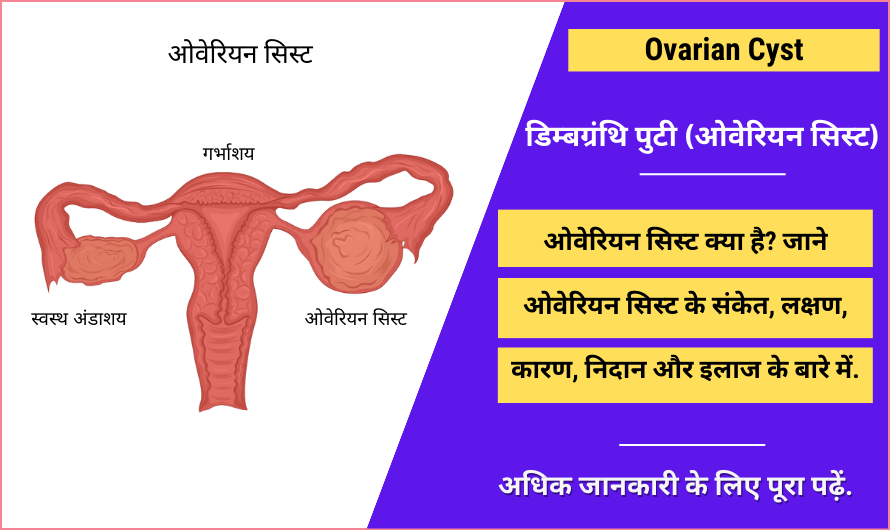 डिम्बग्रंथि पुटी (ओवेरियन सिस्ट) – Ovarian Cyst in Hindi